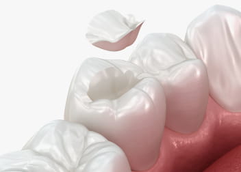 代表的な銀歯を白い歯にする治療