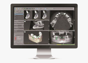 最新の歯科用CTや三次元コンピュータ画像で高い安全性
