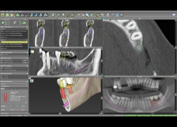 三次元コンピュータ画像でインプラント手術のシミュレーションを行う