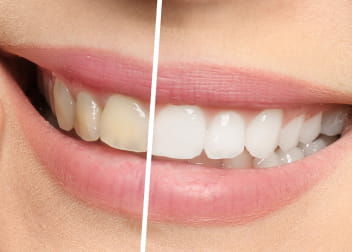 天然歯を白く改善させるホワイトニング